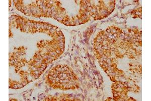 IHC image of ABIN7127362 diluted at 1:90 and staining in paraffin-embedded human endometrial cancer performed on a Leica BondTM system.