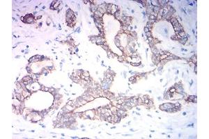 Immunohistochemical analysis of paraffin-embedded stomach cancer tissues using KRT19 mouse mAb with DAB staining. (Cytokeratin 19 anticorps  (AA 80-400))