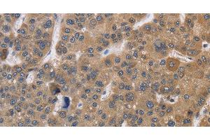 Immunohistochemistry of paraffin-embedded Human liver cancer using SDCCAG3 Polyclonal Antibody at dilution of 1:30 (SDCCAG3 anticorps)