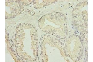 Immunohistochemistry of paraffin-embedded human prostate cancer using ABIN7153936 at dilution of 1:100 (GID8/C20orf11 anticorps  (AA 1-228))