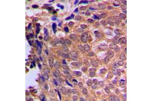 Immunohistochemical analysis of Cofilin staining in human breast cancer formalin fixed paraffin embedded tissue section.
