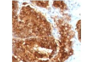 IHC staining of human prostate carcinoma with TAG-72 antibody (TAG-72 anticorps)