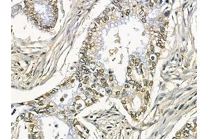 ZIP7 Mouse Monoclonal Antibody at 1/100 staining human pancreatic cancer by IHC-P. (SLC39A7 anticorps)