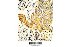 Formalin-fixed and paraffin-embedded human Lung carcinoma reacted with RARS2 Antibody , which was peroxidase-conjugated to the secondary antibody, followed by DAB staining. (RARS2 anticorps  (C-Term))