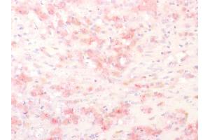 Formalin-fixed, paraffin-embedded human Melanoma stained with TYRP1 Rabbit Polyclonal Antibody using AEC Chromogen (red).