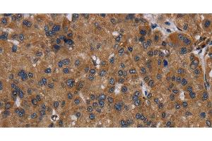 Immunohistochemistry of paraffin-embedded Human liver cancer using NDUFS8 Polyclonal Antibody at dilution of 1:50 (NDUFS8 anticorps)