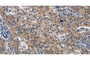 Immunohistochemistry of paraffin-embedded Human gastric cancer using CD160 Polyclonal Antibody at dilution of 1:30 (CD160 anticorps)