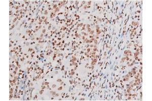 ABIN6267601 at 1/200 staining Human ganstric cancer tissue sections by IHC-P.