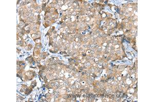 Immunohistochemistry of Human breast cancer using SESN2 Polyclonal Antibody at dilution of 1:30