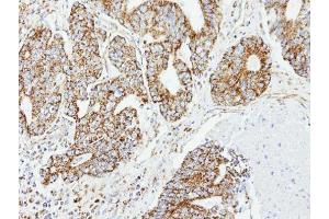 IHC-P Image Immunohistochemical analysis of paraffin-embedded OVCA xenograft, using DCI, antibody at 1:100 dilution. (DCI anticorps)