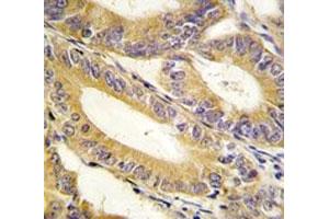 IHC analysis of FFPE human colon carcinoma tissue stained with XIAP antibody