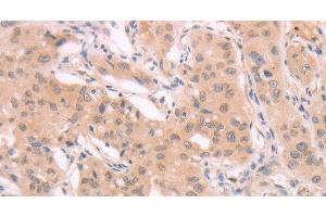 Immunohistochemistry of paraffin-embedded Human breast cancer using ADAM11 Polyclonal Antibody at dilution of 1:40 (ADAM11 anticorps)