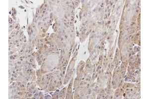 IHC-P Image Immunohistochemical analysis of paraffin-embedded Cal27 xenograft, using Copine I, antibody at 1:100 dilution.