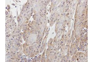 IHC-P Image Immunohistochemical analysis of paraffin-embedded Cal27 xenograft, using Copine I, antibody at 1:100 dilution. (CPNE1 anticorps)