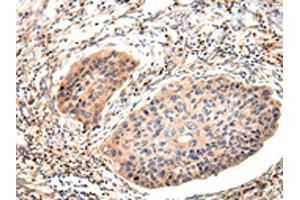 The image on the left is immunohistochemistry of paraffin-embedded Human esophagus cancer tissue using ABIN7191260(Lambda Light chain Antibody) at dilution 1/20, on the right is treated with synthetic peptide. (IGLV1-51 anticorps)