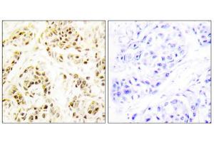 Immunohistochemistry analysis of paraffin-embedded human breast carcinoma tissue using FEN1 antibody. (FEN1 anticorps  (Internal Region))