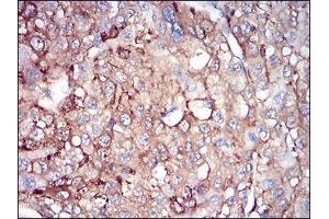 Immunohistochemical analysis of paraffin-embedded liver cancer tissues using FTL mouse mAb with DAB staining. (FTL anticorps  (full length))