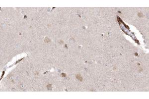 ABIN6273037 at 1/100 staining Human brain cancer tissue by IHC-P.