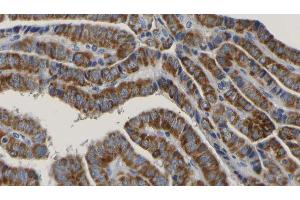 ABIN6267171 at 1/100 staining Human thyroid cancer tissue by IHC-P. (RIPK1 anticorps  (pSer166))