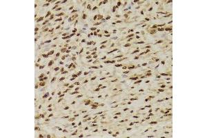 Immunohistochemistry of paraffin-embedded human adenomyosis using ANP32A Antibody.
