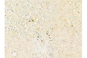 ABIN6261540 and ABIN6272998 at 1/100 staining human hepatocellular carcinoma by IHC-P.