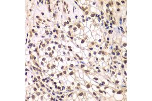 Immunohistochemistry of paraffin-embedded human kidney cancer using SMARCC1 antibody. (SMARCC1 anticorps  (AA 80-320))