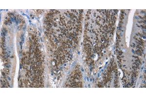 Immunohistochemistry of paraffin-embedded Human colon cancer tissue using GNRH1 Polyclonal Antibody at dilution 1:65 (GNRH1 anticorps)