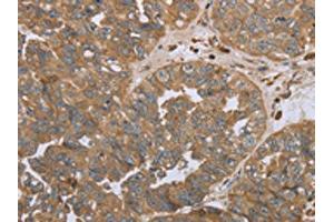 The image on the left is immunohistochemistry of paraffin-embedded Human ovarian cancer tissue using ABIN7191695(NPR2 Antibody) at dilution 1/45, on the right is treated with synthetic peptide. (NPR2 anticorps)