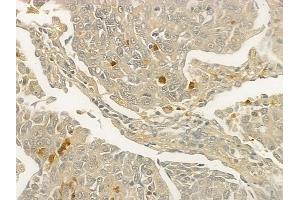 ABIN6257971 and ABIN6273840 at 1/100 staining human lung squamous cell carcinoma by IHC-P. (CCR1 anticorps  (N-Term))