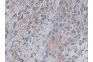 Detection of RALA in Human Lung cancer Tissue using Monoclonal Antibody to V-Ral Simian Leukemia Viral Oncogene Homolog A (RALA) (rala anticorps  (AA 1-206))