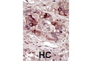 Formalin-fixed and paraffin-embedded human cancer tissue reacted with the primary antibody, which was peroxidase-conjugated to the secondary antibody, followed by DAB staining.