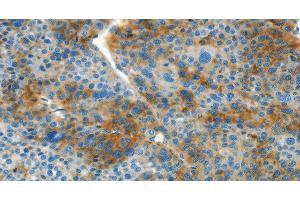 Immunohistochemistry of paraffin-embedded Human liver cancer tissue using L1CAM Polyclonal Antibody at dilution 1:40
