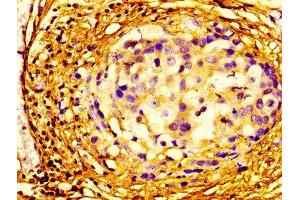Immunohistochemistry of paraffin-embedded human breast cancer using ABIN7152106 at dilution of 1:100