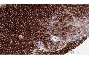 ABIN6276511 at 1/100 staining Human urothelial cancer tissue by IHC-P.