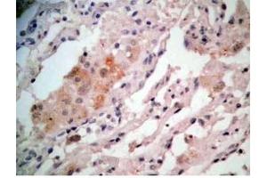 Human lung cancer tissue stained by Rabbit-Anti-GRP Pro (80-97) (H) Antibody