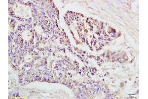 Formalin-fixed and paraffin-embedded human rectal carcinoma labeled with Rabbit Anti-HLA-E Polyclonal Antibody , Unconjugated at 1:200 followed by conjugation to the secondary antibody and DAB staining