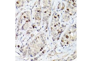 Immunohistochemistry of paraffin-embedded human breast cancer using RG Rabbit pAb (ABIN6127968, ABIN6146621, ABIN6220915 and ABIN6220916) at dilution of 1:50 (40x lens).