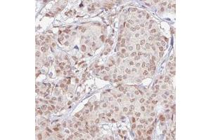 Immunohistochemical staining (Formalin-fixed paraffin-embedded sections) of human breast cancer with RBM3 monoclonal antibody, clone CL0296  shows moderate nuclear positivity in tumor cells. (RBM3 anticorps)