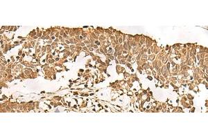 Immunohistochemistry of paraffin-embedded Human lung cancer tissue using PSMA3 Polyclonal Antibody at dilution of 1:50(x200) (PSMA3 anticorps)