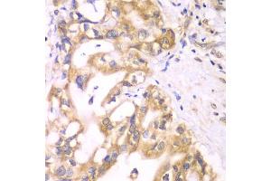 Immunohistochemistry of paraffin-embedded human liver cancer using ACADS antibody (ABIN5970342) at dilution of 1/100 (40x lens). (ACADS anticorps)