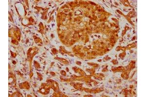 IHC image of ABIN7127852 diluted at 1:210 and staining in paraffin-embedded human pancreatic cancer performed on a Leica BondTM system.