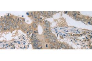Immunohistochemistry of paraffin-embedded Human colon cancer tissue using P2RY11 Polyclonal Antibody at dilution of 1:30(x200) (P2RY11 anticorps)
