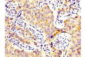 IHC image of ABIN7147182 diluted at 1:300 and staining in paraffin-embedded human pancreatic cancer performed on a Leica BondTM system. (CD82 anticorps  (AA 111-228))