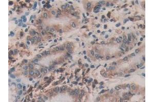 Detection of PDIA4 in Human Stomach cancer Tissue using Polyclonal Antibody to Protein Disulfide Isomerase A4 (PDIA4)