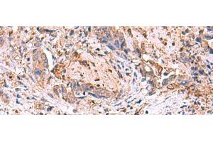 Immunohistochemistry of paraffin-embedded Human cervical cancer tissue using MPP1 Polyclonal Antibody at dilution of 1:50(x200) (MPP1 anticorps)