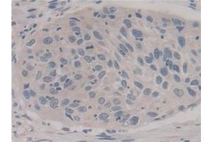 Detection of FIS1 in Human Lung cancer Tissue using Polyclonal Antibody to Fission 1 (FIS1)