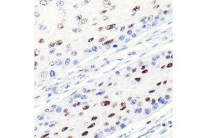 Immunohistochemistry of paraffin-embedded human esophageal cancer using CDKN1A/p21CIP1 Rabbit mAb (ABIN7266599) at dilution of 1:100 (40x lens).