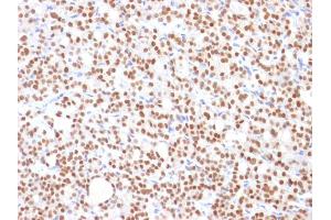 Formalin-fixed, paraffin-embedded human Thyroid Carcinoma stained with PAX8 Mouse Monoclonal Antibody (PAX8/1492).
