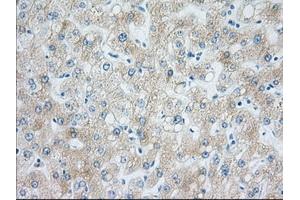 Immunohistochemical staining of paraffin-embedded Carcinoma of Human liver tissue using anti-H6PD mouse monoclonal antibody. (Glucose-6-Phosphate Dehydrogenase anticorps)