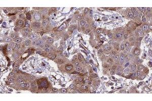 ABIN6276667 at 1/100 staining Human liver cancer tissue by IHC-P.